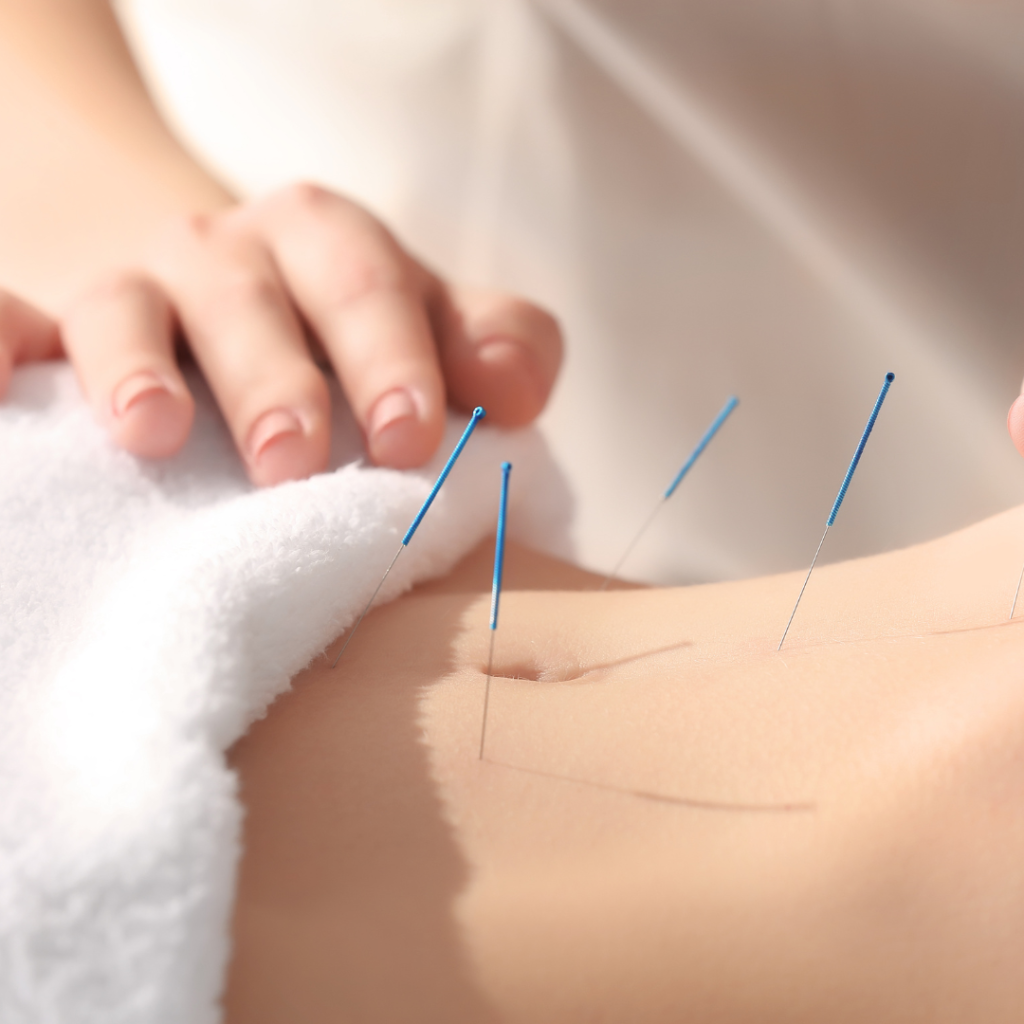 Akupresura